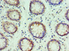 Immunohistochemistry of paraffin-embedded human colon cancer using CSB-PA011815ESR1HU at dilution of 1:100