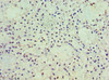 Immunohistochemistry of paraffin-embedded human breast cancer using CSB-PA619962ESR2HU at dilution of 1:100