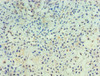 Immunohistochemistry of paraffin-embedded human breast cancer using CSB-PA019047DSR1HU at dilution of 1:100