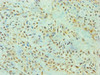 Immunohistochemistry of paraffin-embedded human breast cancer using CSB-PA687492ESR1HU at dilution of 1:100