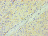 Immunohistochemistry of paraffin-embedded human liver cancer using CSB-PA004925ESR2HU at dilution of 1:100
