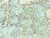 Immunohistochemistry of paraffin-embedded human breast cancer using CSB-PA026691ESR1HU at dilution of 1:100