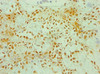 Immunohistochemistry of paraffin-embedded human breast cancer using CSB-PA026691ESR2HU at dilution of 1:100