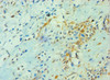 Immunohistochemistry of paraffin-embedded human breast cancer using CSB-PA026290ESR1HU at dilution of 1:100