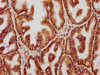 IHC image of CSB-PA026290ESR1HU diluted at 1:221 and staining in paraffin-embedded human prostate tissue performed on a Leica BondTM system. After dewaxing and hydration, antigen retrieval was mediated by high pressure in a citrate buffer (pH 6.0) . Section was blocked with 10% normal goat serum 30min at RT. Then primary antibody (1% BSA) was incubated at 4°C overnight. The primary is detected by a biotinylated secondary antibody and visualized using an HRP conjugated SP system.