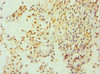 Immunohistochemistry of paraffin-embedded human breast cancer using CSB-PA623920ESR2HU at dilution of 1:100