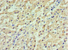 Immunohistochemistry of paraffin-embedded human liver cancer using CSB-PA009971ESR2HU at dilution of 1:100