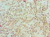 Immunohistochemistry of paraffin-embedded human breast cancer using CSB-PA002198ESR1HU at dilution of 1:100