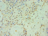 Immunohistochemistry of paraffin-embedded human breast cancer using CSB-PA883647ESR1HU at dilution of 1:100