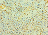 Immunohistochemistry of paraffin-embedded human breast cancer using CSB-PA012953ESR1HU at dilution of 1:100