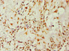 Immunohistochemistry of paraffin-embedded human breast cancer using CSB-PA001568ESR1HU at dilution of 1:100