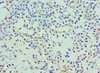 Immunohistochemistry of paraffin-embedded human breast cancer using CSB-PA859111ESR1HU at dilution of 1:100