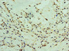 Immunohistochemistry of paraffin-embedded human breast cancer using CSB-PA026425DSR2HU at dilution of 1:100