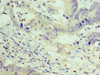 Immunohistochemistry of paraffin-embedded human colon cancer using CSB-PA026425DSR2HU at dilution of 1:100