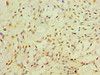 Immunohistochemistry of paraffin-embedded human breast cancer using CSB-PA019572DSR1HU at dilution of 1:100