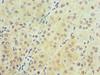 Immunohistochemistry of paraffin-embedded human liver cancer using CSB-PA711453ESR2HU at dilution of 1:100