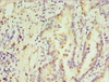 Immunohistochemistry of paraffin-embedded human lung cancer using CSB-PA613388DSR1HU at dilution of 1: 100