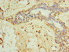 Immunohistochemistry of paraffin-embedded human breast cancer using CSB-PA810313ESR1HU at dilution of 1:100