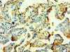 Immunohistochemistry of paraffin-embedded human lung cancer using CSB-PA015364DSR2HU at dilution of 1:100