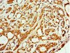 Immunohistochemistry of paraffin-embedded human breast cancer using CSB-PA885676ESR1HU at dilution of 1:100