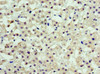 Immunohistochemistry of paraffin-embedded human liver cancer using CSB-PA885676ESR1HU at dilution of 1:100