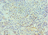 Immunohistochemistry of paraffin-embedded human breast cancer using CSB-PA006737DSR2HU at dilution of 1:100