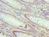 Immunohistochemistry of paraffin-embedded human colon cancer using CSB-PA006737DSR2HU at dilution of 1:100