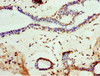 Immunohistochemistry of paraffin-embedded human breast cancer using CSB-PA619083ESR2HU at dilution of 1:100