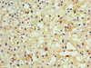 Immunohistochemistry of paraffin-embedded human liver cancer using CSB-PA619083ESR2HU at dilution of 1:100