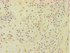 Immunohistochemistry of paraffin-embedded human breast cancer using CSB-PA002369ESR1HU at dilution of 1:100