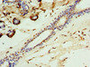 Immunohistochemistry of paraffin-embedded human breast cancer using CSB-PA004435ESR1HU at dilution of 1:100