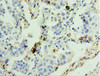 Immunohistochemistry of paraffin-embedded human lung cancer using CSB-PA009973ESR1HU at dilution of 1:100