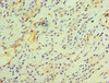 Immunohistochemistry of paraffin-embedded human breast cancer using CSB-PA008793ESR1HU at dilution of 1:100