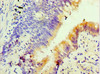 Immunohistochemistry of paraffin-embedded human lung cancer using CSB-PA008793ESR1HU at dilution of 1:100