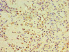 Immunohistochemistry of paraffin-embedded human breast cancer using CSB-PA822187ESR1HU at dilution of 1:100