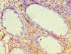 Immunohistochemistry of paraffin-embedded human colon cancer using CSB-PA822187ESR1HU at dilution of 1:100