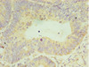 Immunohistochemistry of paraffin-embedded human colon cancer using CSB-PA005558ESR1HU at dilution of 1:100