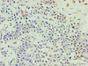 Immunohistochemistry of paraffin-embedded human breast cancer using CSB-PA001076ESR2HU at dilution of 1:100