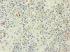 Immunohistochemistry of paraffin-embedded human breast cancer using CSB-PA871400ESR2HU at dilution of 1:100