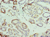 Immunohistochemistry of paraffin-embedded human breast cancer using CSB-PA621669DSR2HU at dilution of 1:100