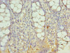Immunohistochemistry of paraffin-embedded human colon cancer using CSB-PA819153ESR1HU at dilution of 1:100