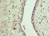 Immunohistochemistry of paraffin-embedded human breast cancer using CSB-PA818781DSR1HU at dilution of 1:100