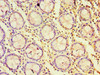 Immunohistochemistry of paraffin-embedded human colon cancer using CSB-PA022880DSR1HU at dilution of 1:100