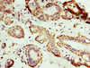 Immunohistochemistry of paraffin-embedded human breast cancer using CSB-PA895771ESR1HU at dilution of 1:100