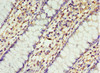 Immunohistochemistry of paraffin-embedded human colon cancer using CSB-PA896713ESR2HU at dilution of 1:100