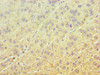 Immunohistochemistry of paraffin-embedded human liver cancer using CSB-PA007537ESR2HU at dilution of 1:100