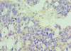 Immunohistochemistry of paraffin-embedded human endometrial cancer using CSB-PA621519ESR2HU at dilution of 1:100