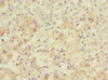 Immunohistochemistry of paraffin-embedded human liver cancer using CSB-PA018491ESR1HU at dilution of 1:100