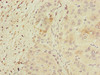Immunohistochemistry of paraffin-embedded human liver cancer using CSB-PA018491ESR2HU at dilution of 1:100