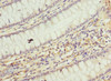 Immunohistochemistry of paraffin-embedded human colon cancer using CSB-PA624102ESR1HU at dilution of 1:100